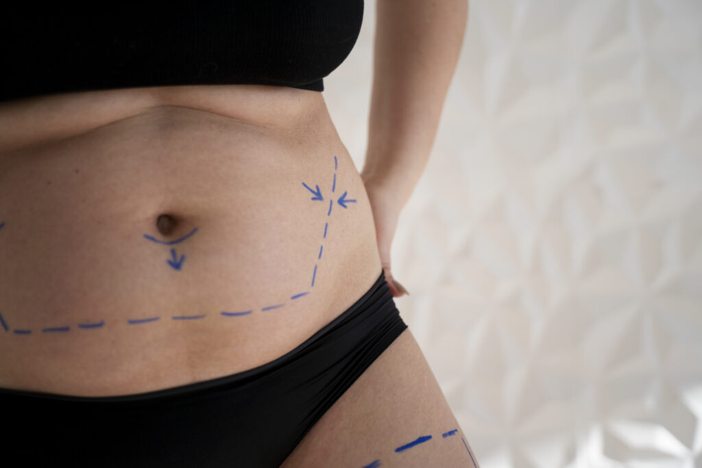 Como Recuperar a Confiança no Corpo Pós-Gestação com a Abdominoplastia